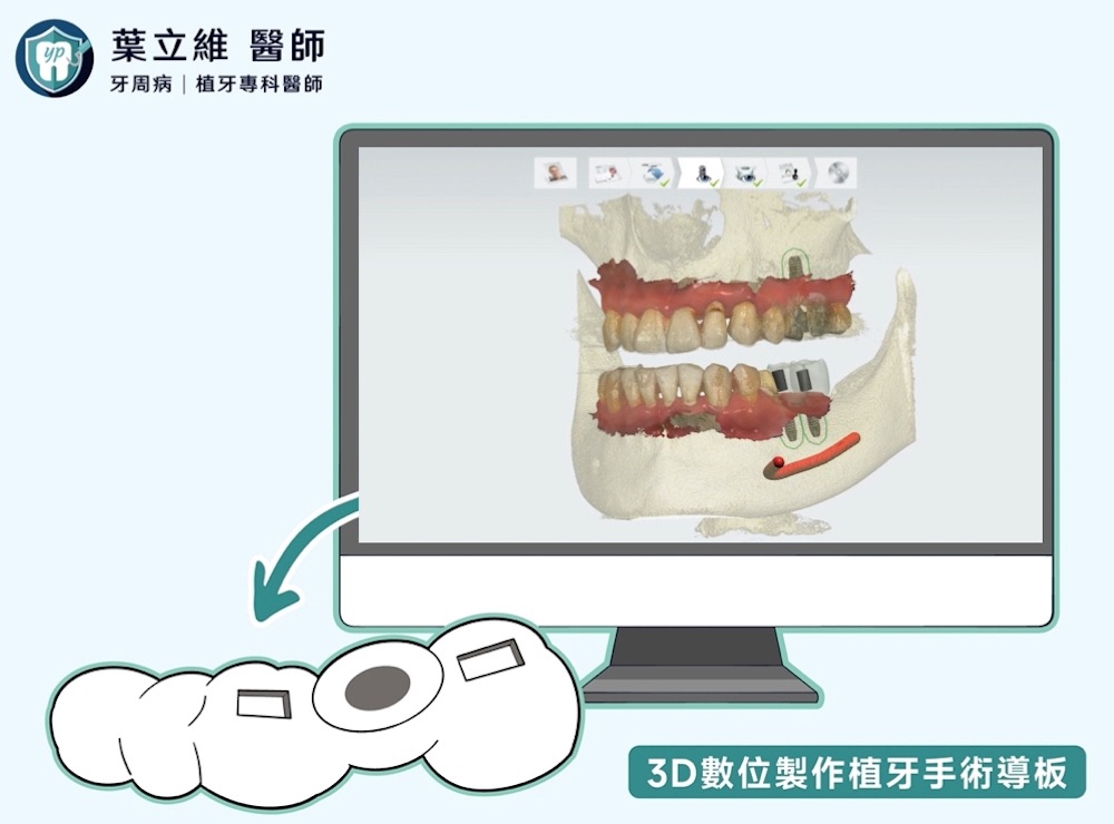 數位植牙要素：完整的數位植牙規劃軟體、數位製作手術導板