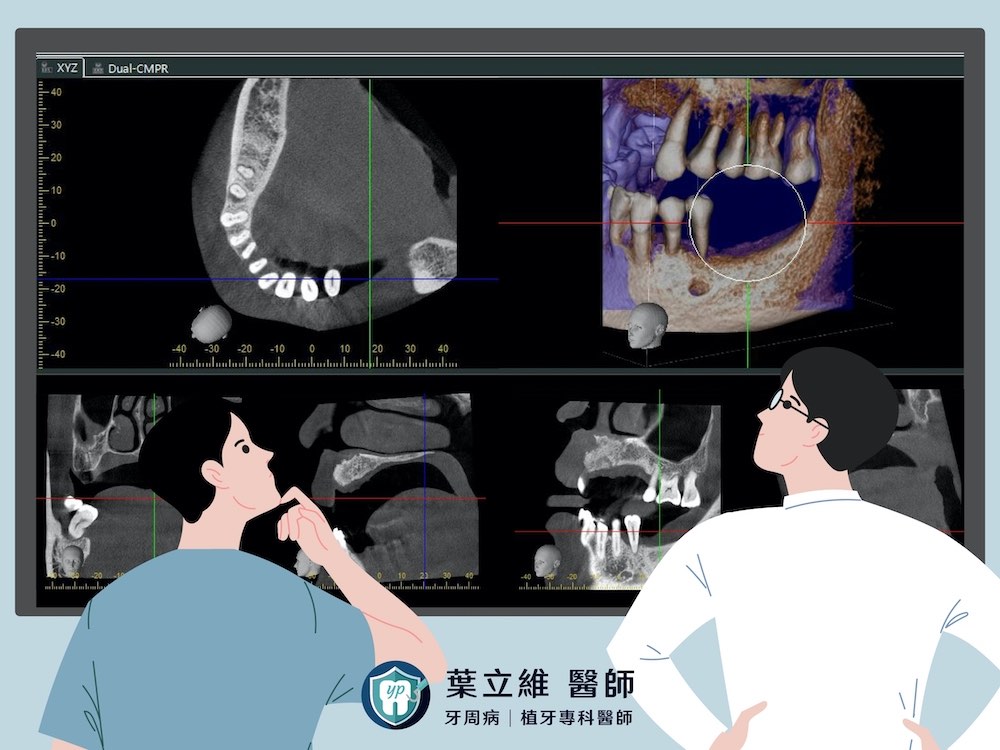 相較平面式X光片，3D電腦斷層影像才能從各角度仔細地評估患者齒槽骨的條件