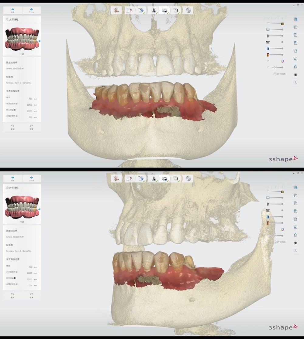 在數位植牙療程設計中，將口內掃描檔和3D電腦斷層影像組合在一起