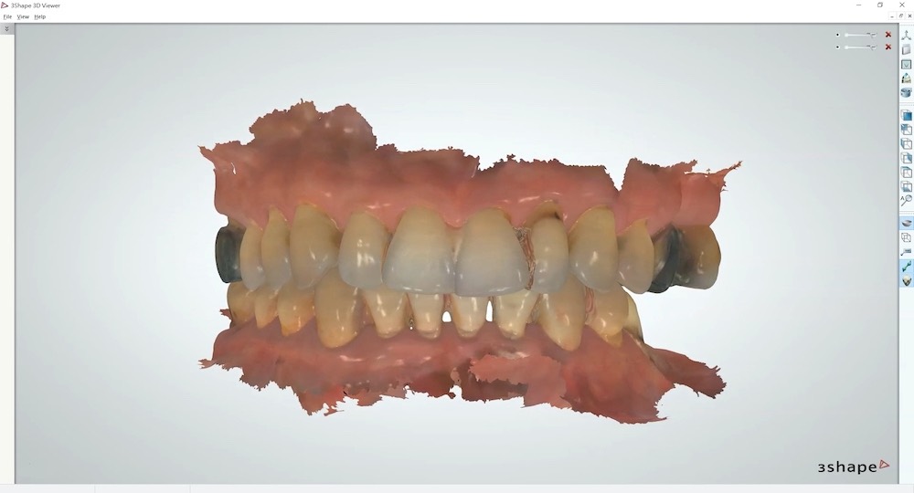 將數位全口虛擬模型記錄到電腦中，讓醫師可依咬合狀況來設計缺牙重建計劃