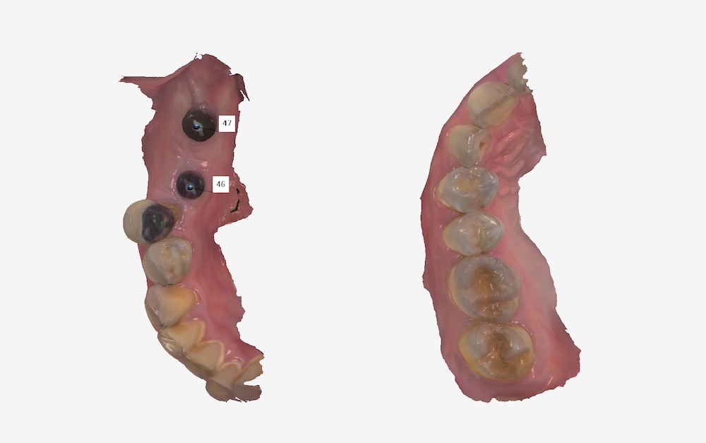 採數位口腔掃描取得右側上、下顎與植體位置的口腔模型