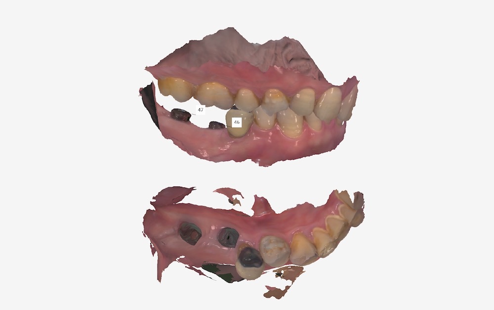 採數位口腔掃描取得右側咬合與植體位置的口腔模型
