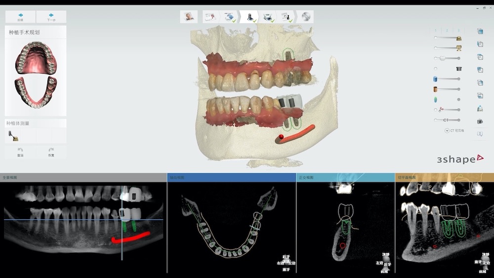 數位植牙流程可在軟體中先標出植牙風險區(例：下顎的下齒槽神經、上顎鼻竇)，排出虛擬的假牙和置入虛擬人工牙根