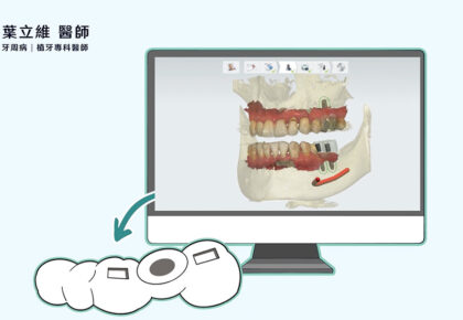 數位植牙是什麼？數位植牙療程與降低失敗率的關鍵因素