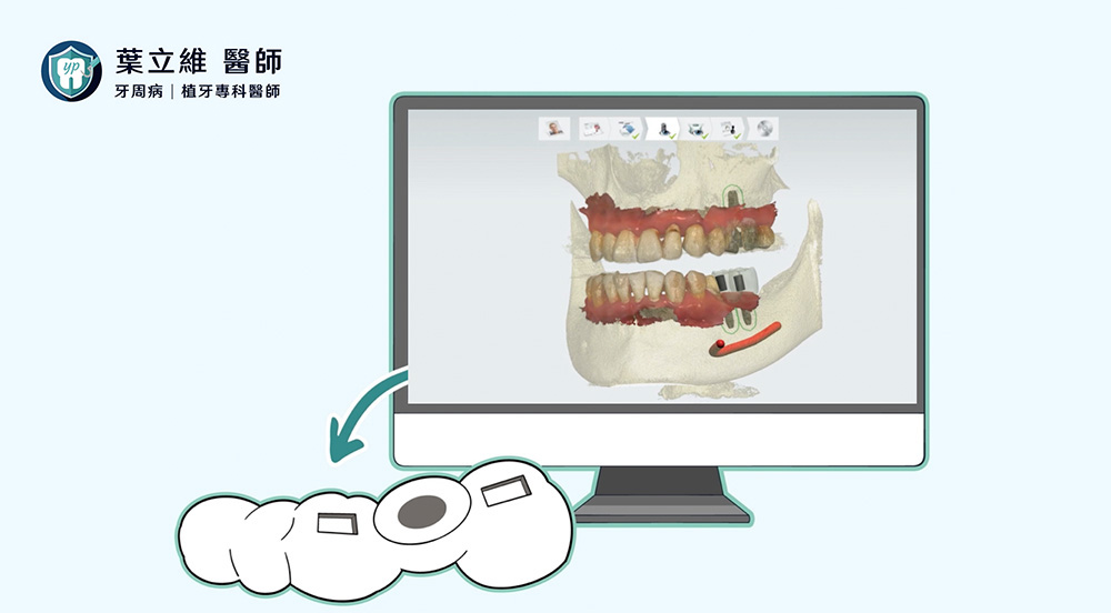 數位植牙是什麼？數位植牙療程與降低失敗率的關鍵因素