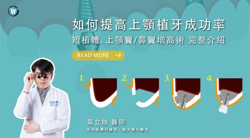 如何提高上顎植牙成功率？短植體、上顎竇/鼻竇增高術 完整介紹