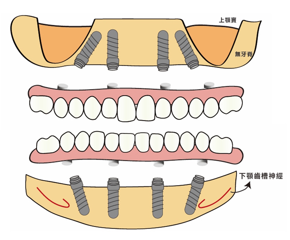 All-on-4治療概念示意圖：避開上顎鼻竇腔、下顎齒槽神經等風險較高區域，於四根植體上安裝整排假牙來恢復咬合功能