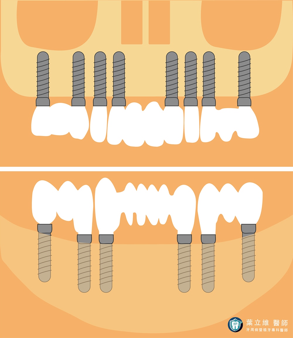 全口植牙治療概念示意圖：全口植牙上顎最少使用8支植體、下顎則是6支植體