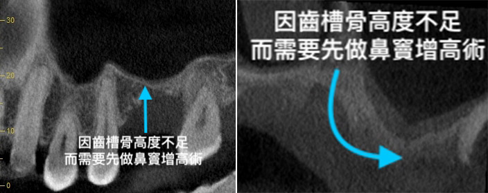 X光顯示齒槽骨高度不足而需要先做鼻竇增高術，植牙時間長的狀況適合用All-on-4全口速定植牙方式重建