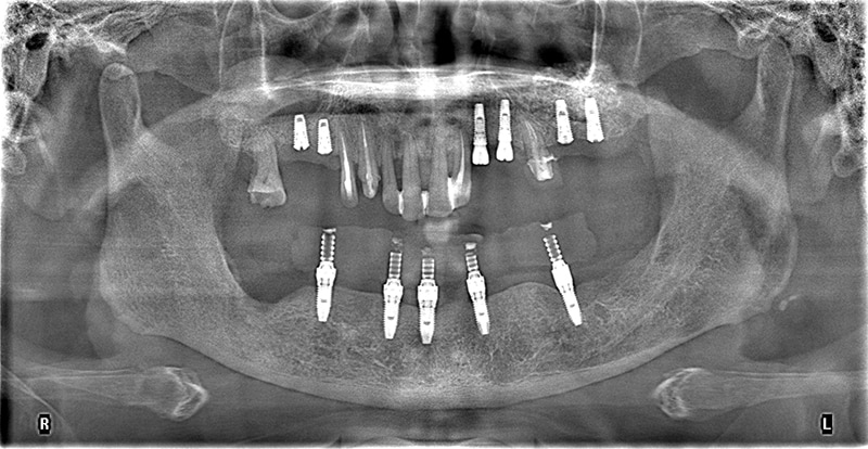 全口重建案例環口X光片：以上顎六顆植牙、下顎All-on-5的方式重建咬合