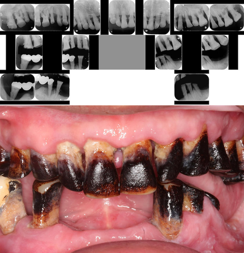全口重建案例治療前：患者因長期抽菸、嚼檳榔導致嚴重牙周病，且下排有大範圍缺牙