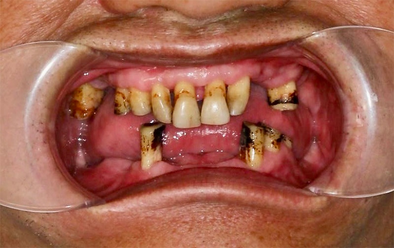 全口重建案例治療中：牙周治療保留部分上顎自然牙，下顎大範圍缺牙將以All-on-5方式重建
