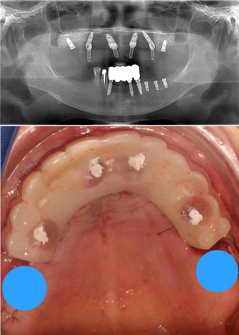 嚴重牙周病案例第一階段All-on-4手術完成後，增加後方兩支植體，延伸可以讓假牙排到後方，增加牙弓長度和未來的咀嚼效率