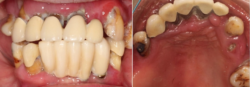 All-on-4流程示意圖(以嚴重牙周病為例)：治療前牙肉紅腫、假牙鬆動，上顎牙無法保留且齒槽骨條件不佳