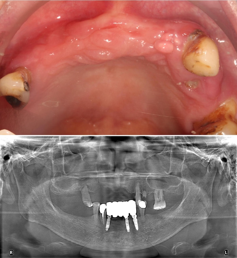 All-on-4流程示意圖(以嚴重牙周病為例)：手術前先拔除上顎鬆動的牙齒，讓牙肉先恢復健康到適合手術的狀態