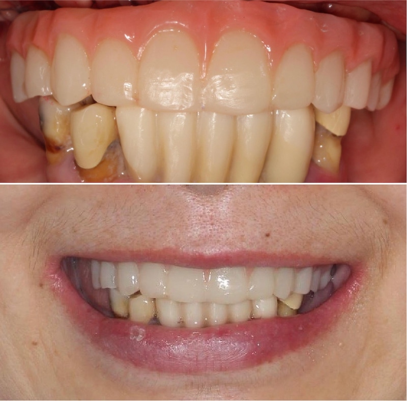 All-on-4流程示意圖(以嚴重牙周病為例)：上午植入植體、下午安裝假牙，一日完成All-on-4全口速定植牙
