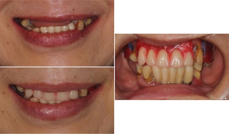 All-on-4流程示意圖(以嚴重牙周病為例)：治療前依照外觀和口內狀況設計排牙，讓患者在口內試戴未來假牙完成的樣子
