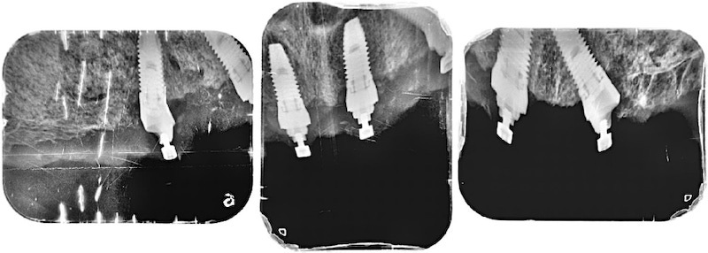 All-on-4流程示意圖(以嚴重牙周病為例)：鎖上All-on-4的假牙專用套件