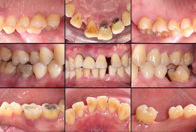 嚴重牙周病治療前，有全口牙齦紅腫、前牙位移且縫隙明顯、後牙缺牙等問題