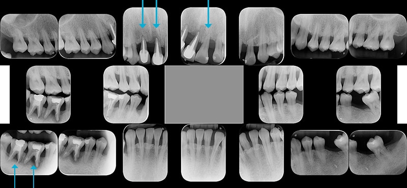 嚴重牙周病治療前，根尖X光片顯示多處骨破壞嚴重
