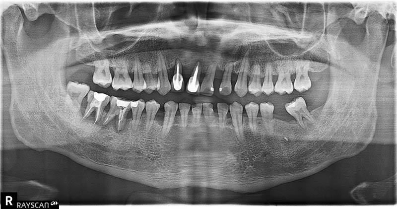 嚴重牙周病治療前，環口X光片顯示全口牙周骨頭流失嚴重