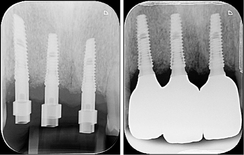 前牙補骨與植牙前後根尖X光片，顯示齒槽骨位置維持穩定狀態