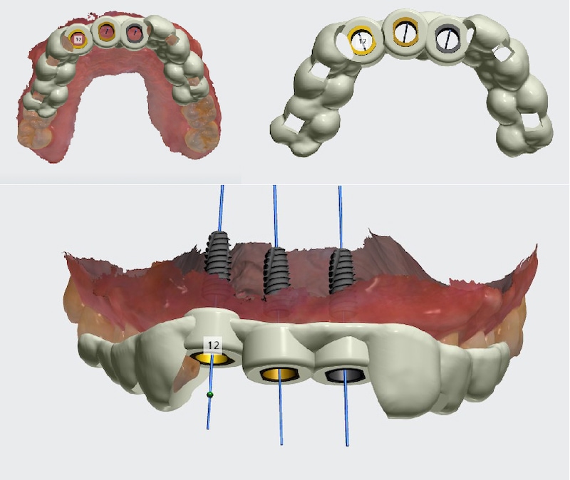 前牙植牙電腦設計輸出數位手術導板