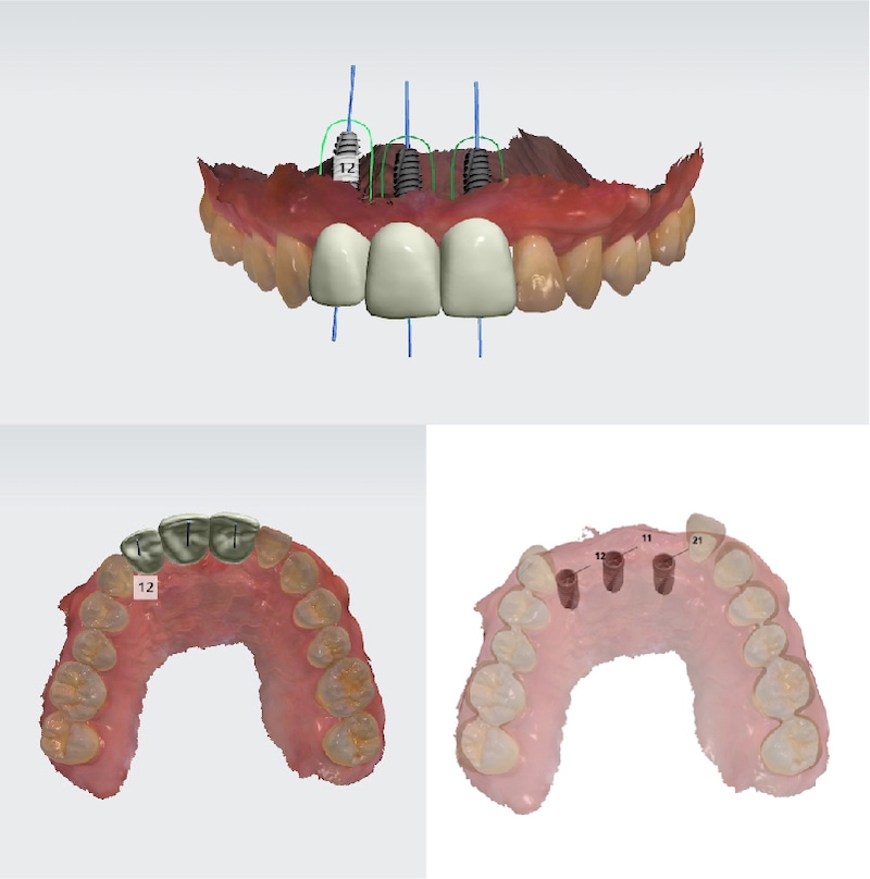 前牙植牙數位模型設計檔案