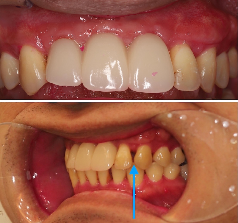 前牙植牙前以臨時假牙模擬外觀，前牙三顆牙齒較寬且縫隙依然清晰可見