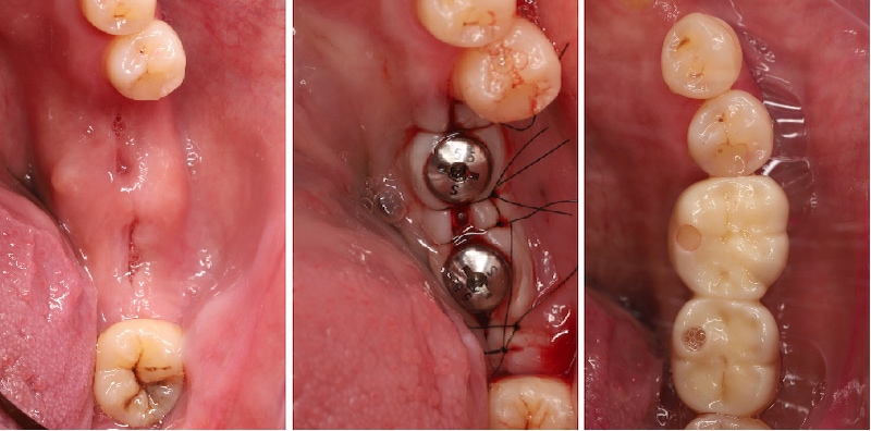 右下第一第二大臼齒植牙前後口內照