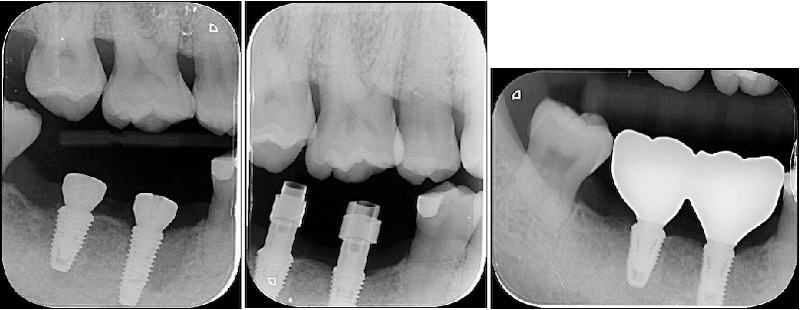 右下第一、第二大臼齒植牙前後Ｘ光片