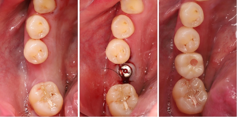 左下第一大臼齒植牙前後口內照