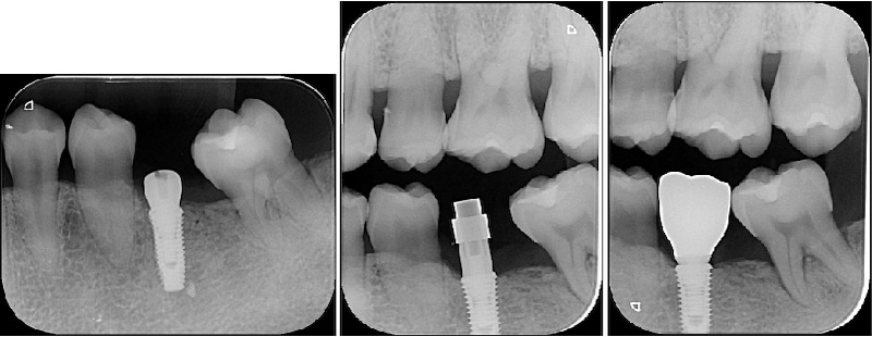 左下第一大臼齒植牙前後Ｘ光片