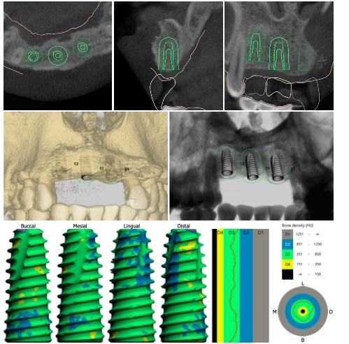數位植牙軟體可標記出植牙的安全距離、骨量、甚至估計植體周圍的骨頭密度