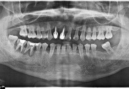 嚴重牙周病治療推薦: 微創植牙/植牙補骨/全瓷貼片/全口重建