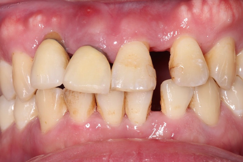 嚴重牙周病植牙前，前牙位移且縫隙明顯