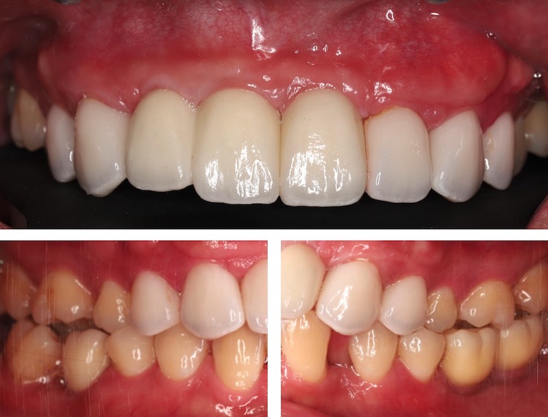 嚴重牙周病採植牙、全瓷貼片進行全口重建，治療後恢復咬合功能與美觀