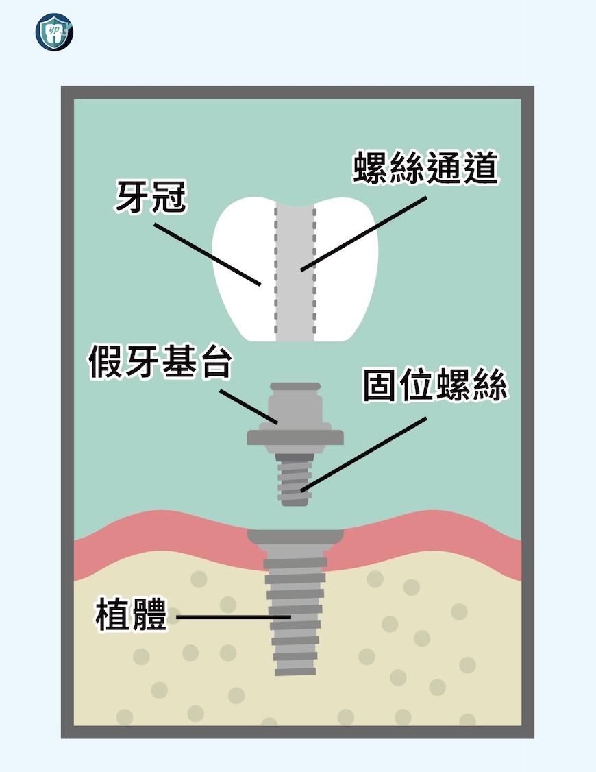 植牙結構示意圖