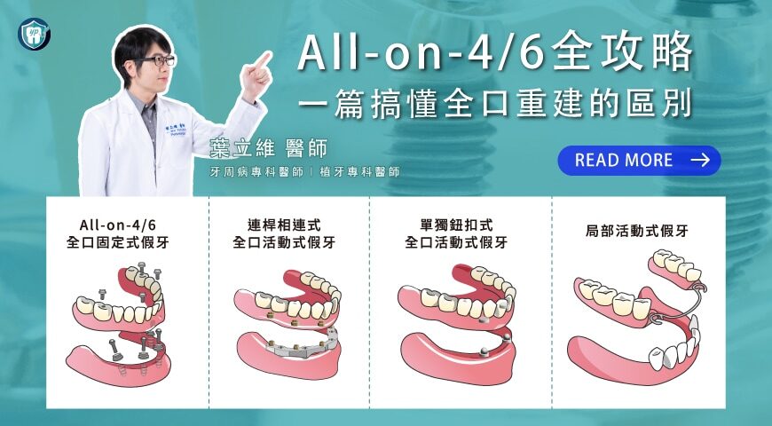 全口重建的選擇方案：全口植牙和全口速定植牙(All-on-4/6/X)有什麼差異？