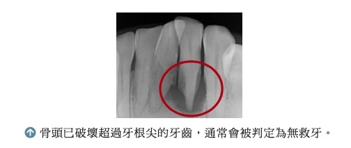 X 光片顯示牙根受損嚴重的牙齒，紅圈標示的部位超過牙根尖病變範圍，通常會被判定為無救牙