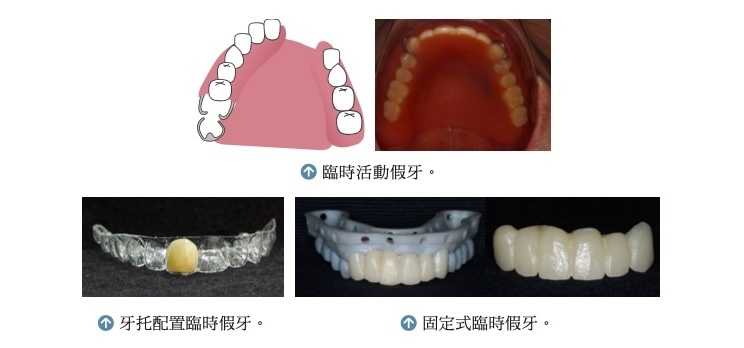 三種常見臨時假牙類型，包括臨時活動假牙、牙托型臨時假牙與固定式臨時假牙的示意與實拍圖