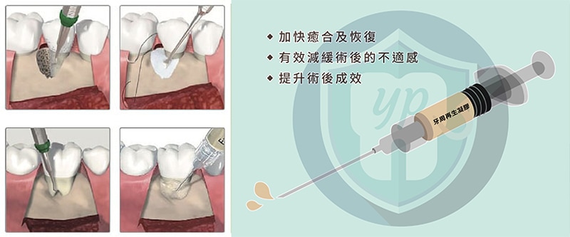 牙周再生手術中,可採用牙釉基質衍生物EMD有效讓失去的牙周組織再生