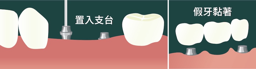 黏著劑固位式植牙假牙