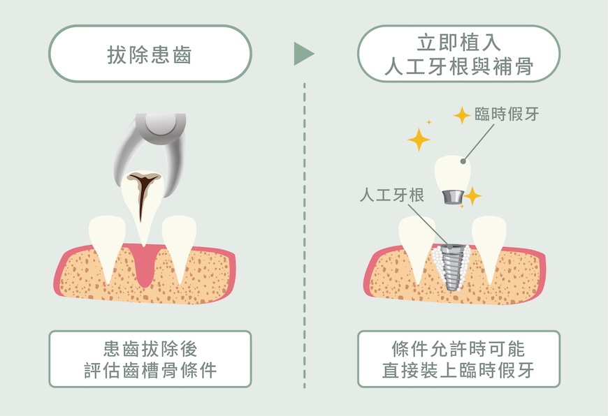 拔除牙齒與立即植入人工牙根的流程圖，說明即拔即種（立即植牙）的手術方式