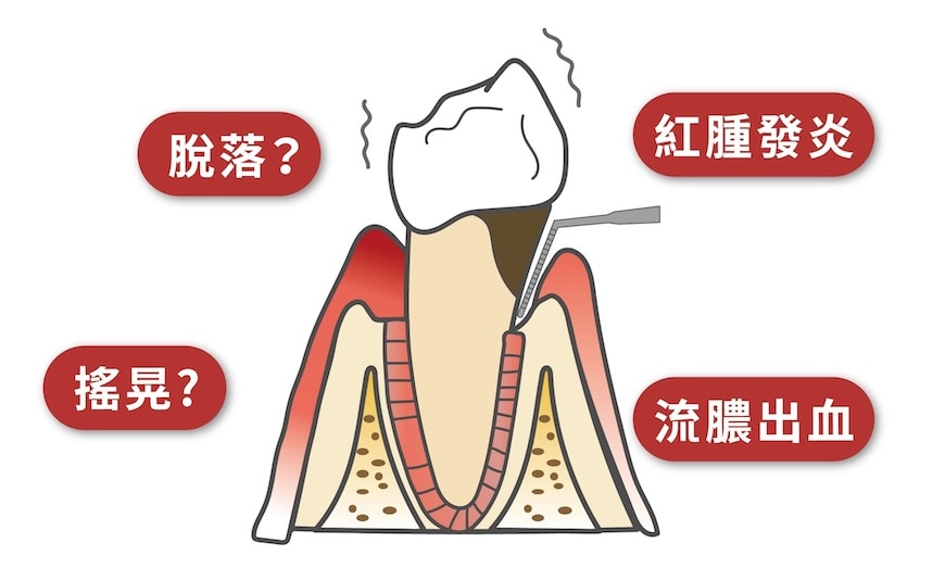 嚴重牙周病導致牙齦紅腫、流膿、牙齒搖晃或脫落的示意圖