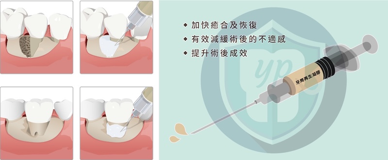 牙周再生手術中，可採用牙釉基質衍生物EMD有效讓失去的牙周組織再生
