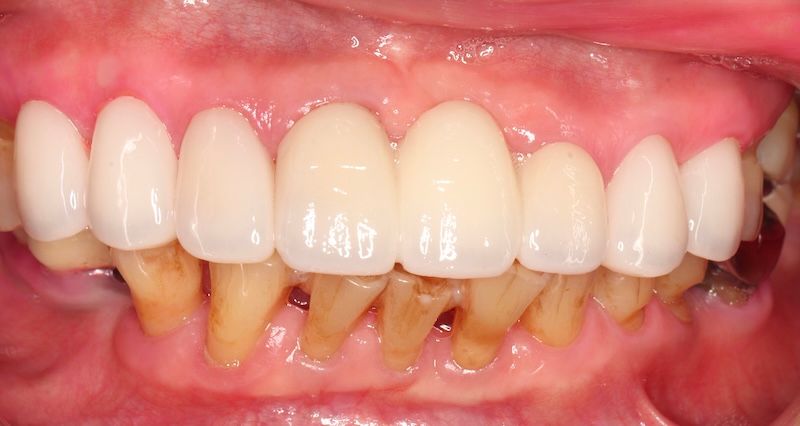 上顎前牙區完成假牙牙橋與全瓷貼片修復後的口內照