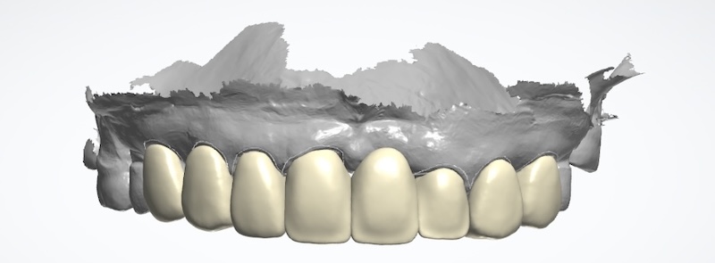 上顎前牙區數位牙科模型電腦設計圖，用於假牙與貼片製作前的規劃