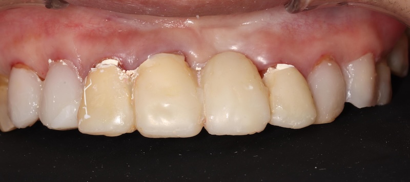 上顎前牙區臨時假牙與複合樹脂試戴，顯示牙齒初步外型溝通狀態