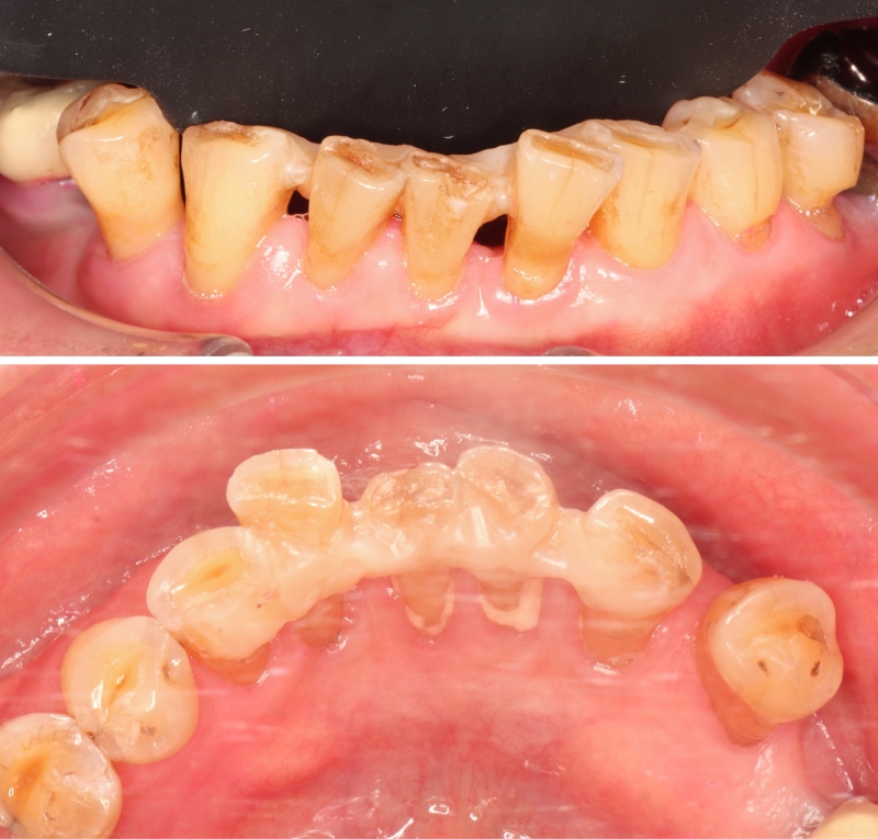 下顎前牙以Ribbond進行齒間固定，穩定鬆動牙齒並預防位置持續偏移